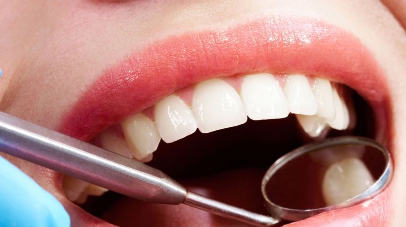 07-2 Delamine toepassing epoxy vullingen tandarts.jpg